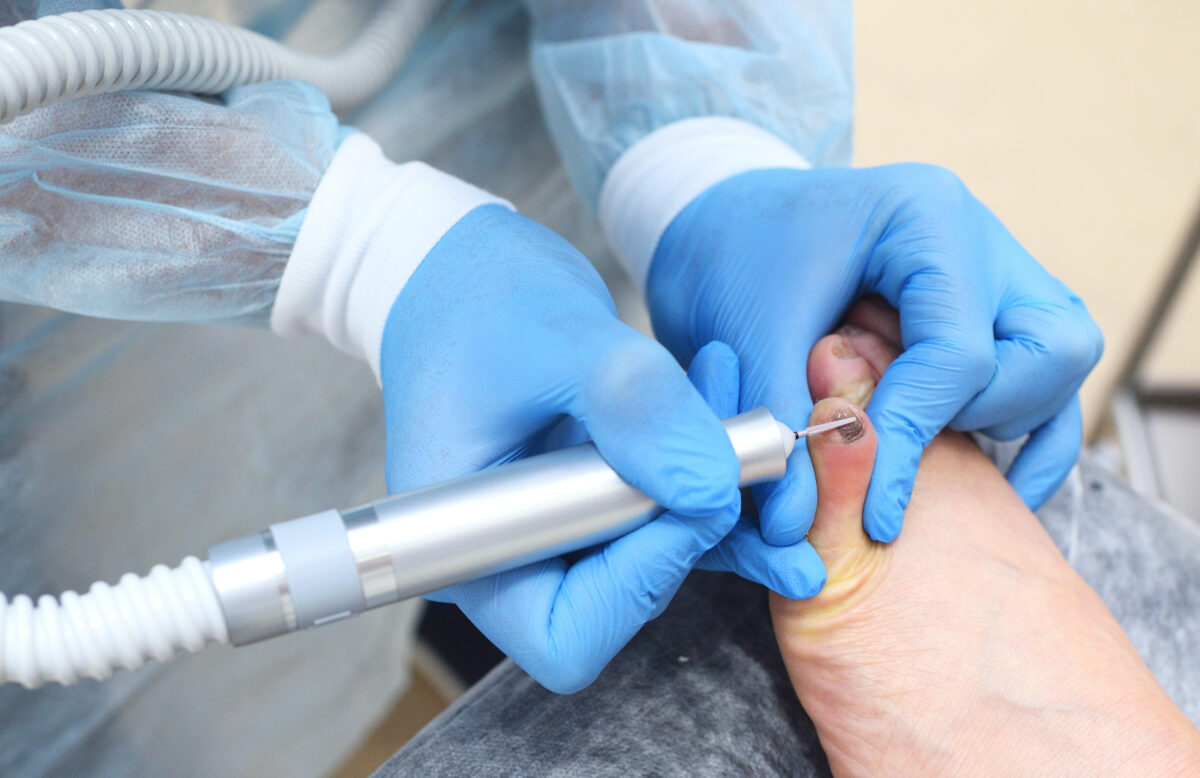 Hardware medical pedicure with a drill and nail files. A patient on a pedicure with a podiatrist. Hardware medical pedicure with a drill for nail files. Onychomycosis, treatment of nail fungus